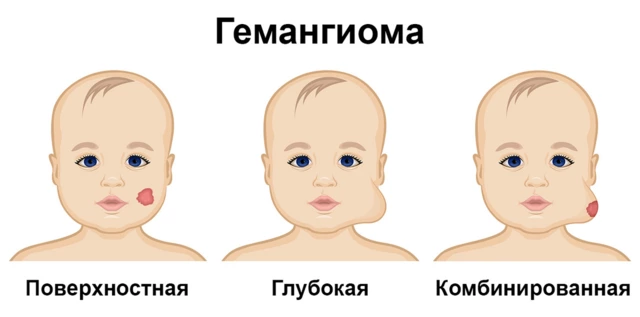 Младенческая гемангиома — СПб ГБУЗ КДЦД