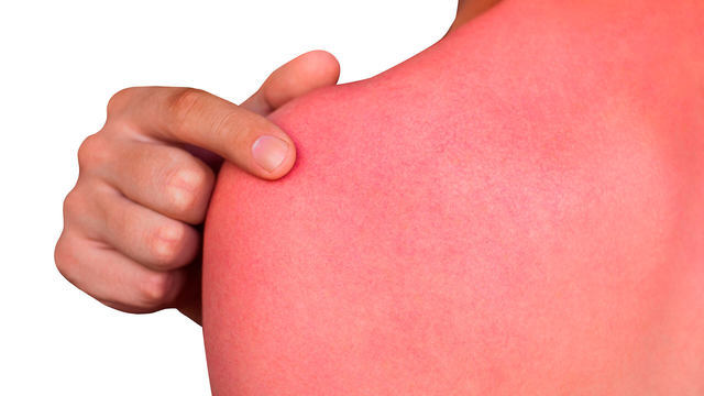 Солнечные ожоги заболевания кожи thumbnail