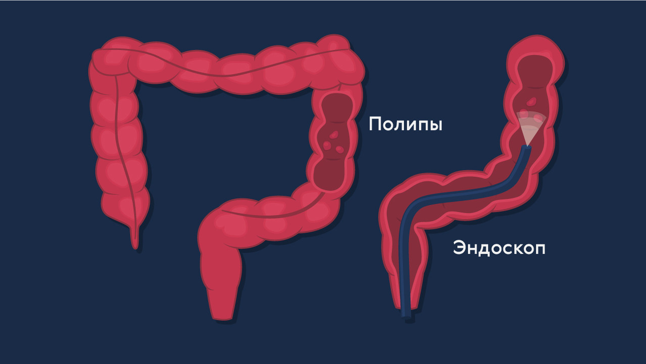 Рак прямой кишки рисунок