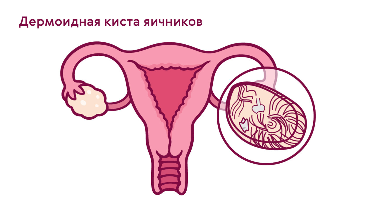 Киста яичника: симптомы у женщин и девушек, признаки кисты, причины появления, лечение - причины, диагностика и лечение
