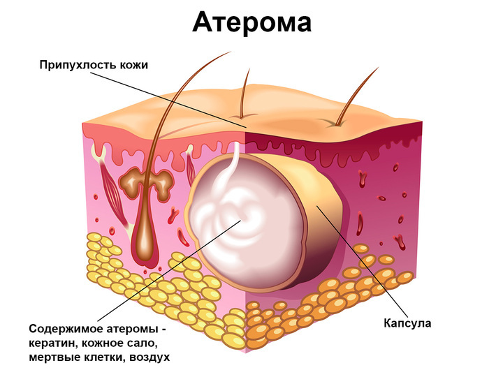 Атерома - симптомы и лечение