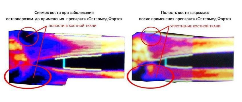 Разряжение костной ткани. Участок разряжения костной структуры. Очаг разряжения костной структуры что это.