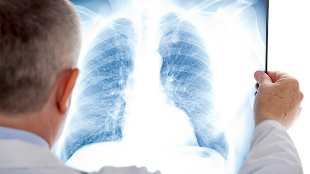 5 факторов риска рака легких и рентгенография