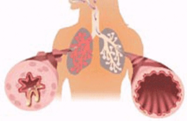 Что такое бронхиальная астма. Пульмонология