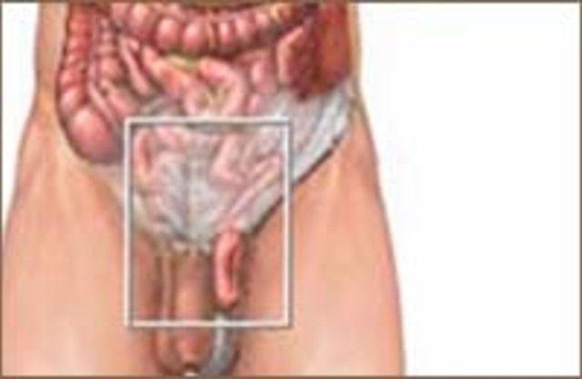 Паховая грыжа у женщин: признаки, симптомы, диагностика, 3 способо удаления, грыжа у беременных