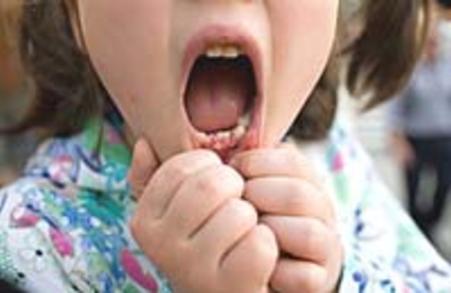 Как лечить хронический тонзиллит. Болезни уха, горла и носа