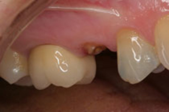 Ученые связали потерю зубов с [несколькими видами рака]