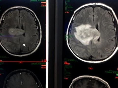 У томского журналиста уменьшилась опухоль мозга после экспериментального лечения в США