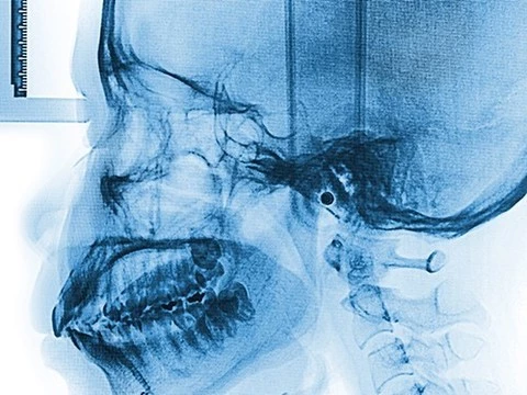 Черепно-мозговые травмы приводят к появлению бета-амилоидных бляшек