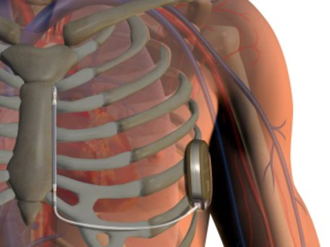 FDA одобрило первый в мире [подкожный дефибриллятор]