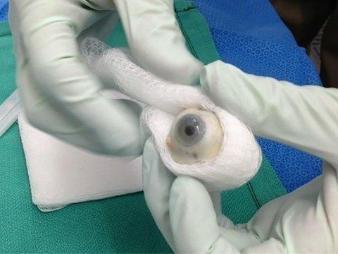 Пересадка роговицы глаза в Турции, цены клиник в Стамбуле