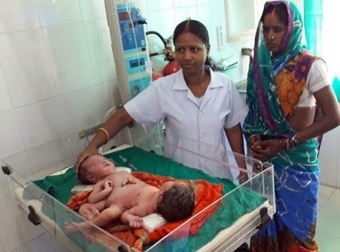 В Индии родились разнополые сиамские близнецы