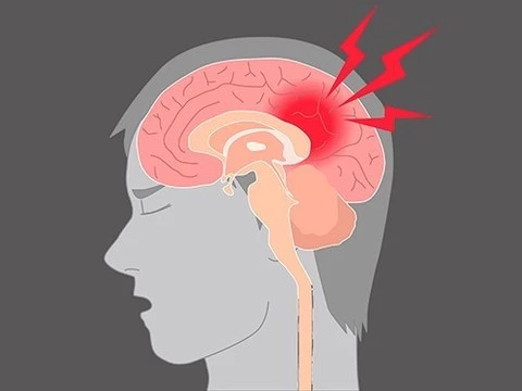 Сотрясение мозга в три раза повышает риск суицида
