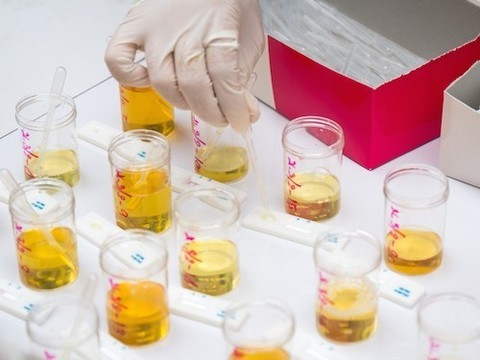Различить биполярное расстройство и клиническую депрессию можно по анализу мочи