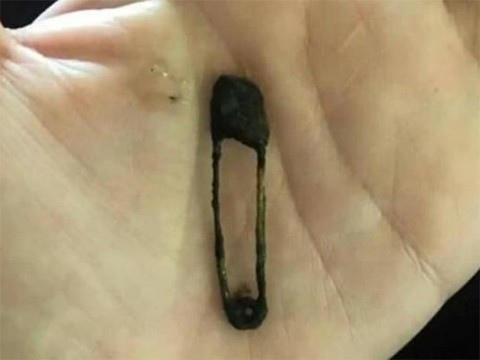 Причиной насморка, длившегося полгода, стала застрявшая в носу английская булавка