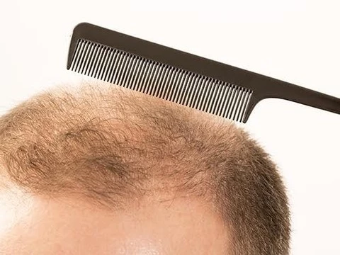 Описаны гены, связанные с выпадением волос в пожилом возрасте