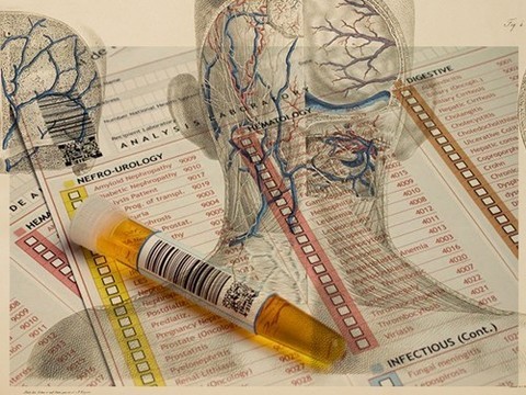 Обнаружить болезнь Крейтцфельдта-Якоба можно будет с помощью анализа мочи
