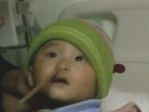 Хирурги извлекли из мозга китайского младенца [палочку для еды]