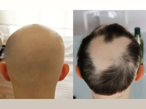 Двум пациентам, страдавшим общей алопецией, вернули волосы