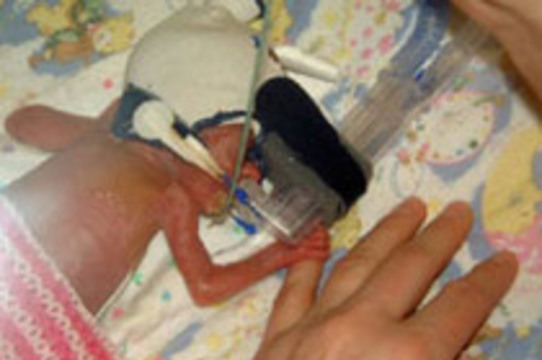Девочка, [родившаяся с весом 354 грамма], выписана из больницы