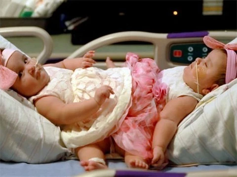 Операция по разделению сиамских близнецов длилась 15 часов