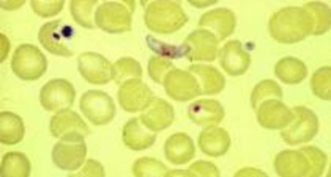 Внутрибольничное заражение малярией оценено в 15 000 фунтов стерлингов