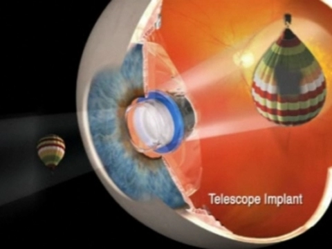 В США разрешили имплантировать [глазные телескопы]