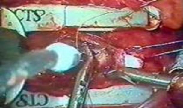 Израильские хирурги впервые успешно имплантировали искусственное сердце