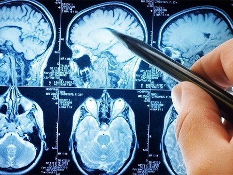 Испытания лекарства от Альцгеймера провалились
