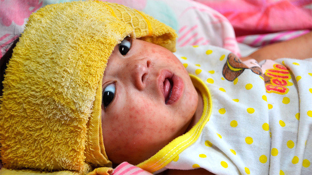 Из-за пандемии 22 миллиона детей во всем мире не получили прививки от кори