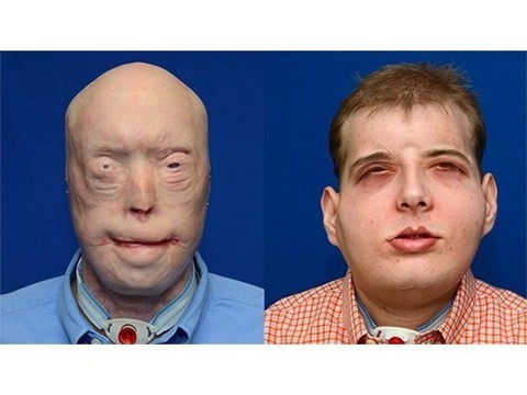 В США проведена сложнейшая операция по пересадке лица
