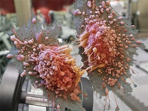 Соль молочной кислоты может вызывать рак