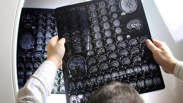Ученые объяснили, почему астматики реже страдают опухолями мозга