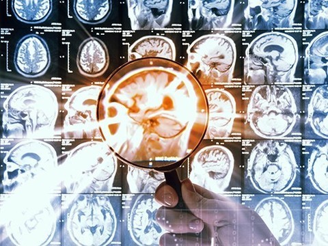 Смертельную детскую опухоль мозга попробуют вылечить новой молекулой