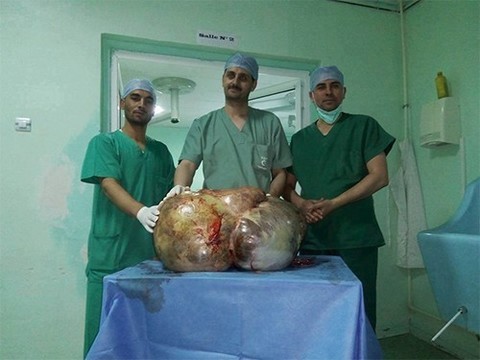Алжирские врачи вырезали пациентке гигантскую опухоль яичников