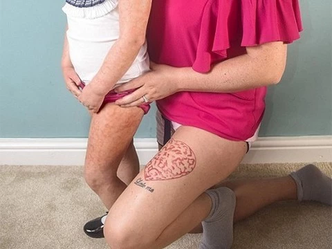 Мать девочки с ихтиозом сделала татуировку, чтобы поддержать дочь