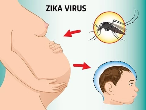Вирус Зика обнаружен в амниотической жидкости заразившихся женщин