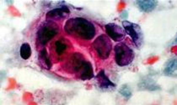Раковые клетки погубят нагреванием