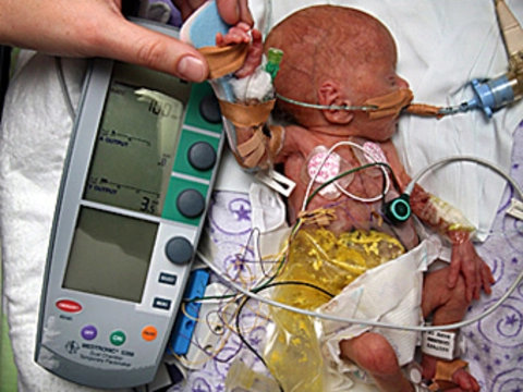 Австралийские врачи установили кардиостимулятор [новорожденной весом в полкилограмма]