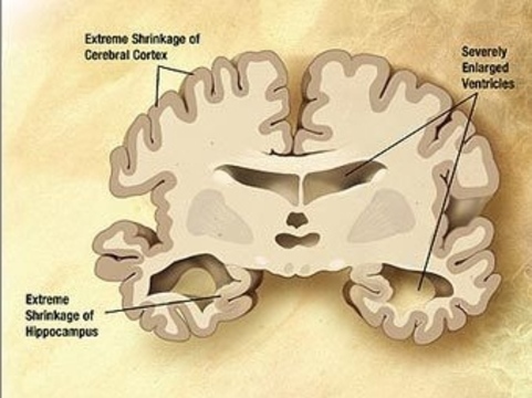 Болезнь альцгеймера фото