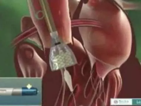 Австралийские врачи успешно [вживили 11 искусственных клапанов сердца без операции]