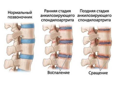 Хроники хроника: болезнь Бехтерева