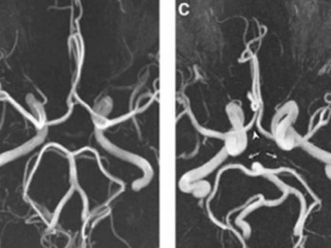 У страдающих мигренью обнаружили [неполный виллизиев круг]