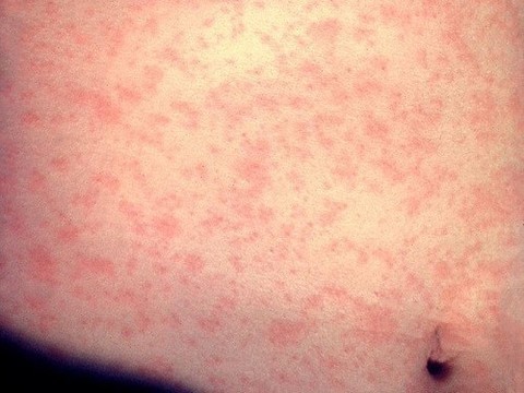 В США впервые за 12 лет зарегистрирована смерть человека от кори