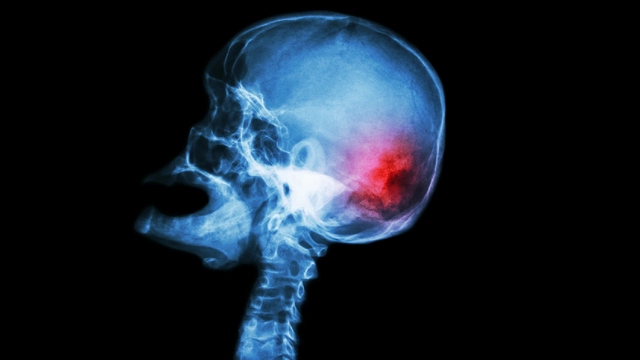 Пока не поздно: как распознать опухоли головы и шеи