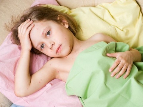 Корь ослабляет иммунитет ребенка на 2-3 года, а не 1-2 месяца