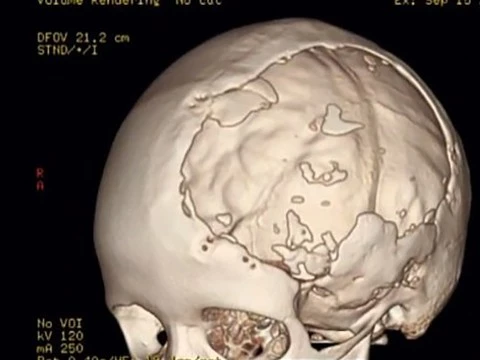 Мальчику, потерявшему почти половину черепа, напечатали новый на 3D-принтере