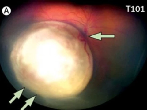 Открыта [новая форма рака сетчатки у младенцев]