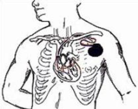 Новый кардиостимулятор спасает пациентов с сердечной недостаточностью
