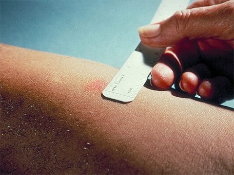 Проба Манту перестает быть монополистом